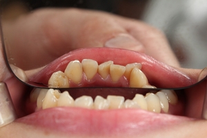 Огромно разнообразие от избелване на зъби 21