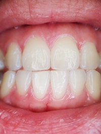 Разнообразие от избелване на зъби 5