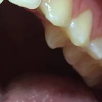 Разгледайте коронки на зъби 7